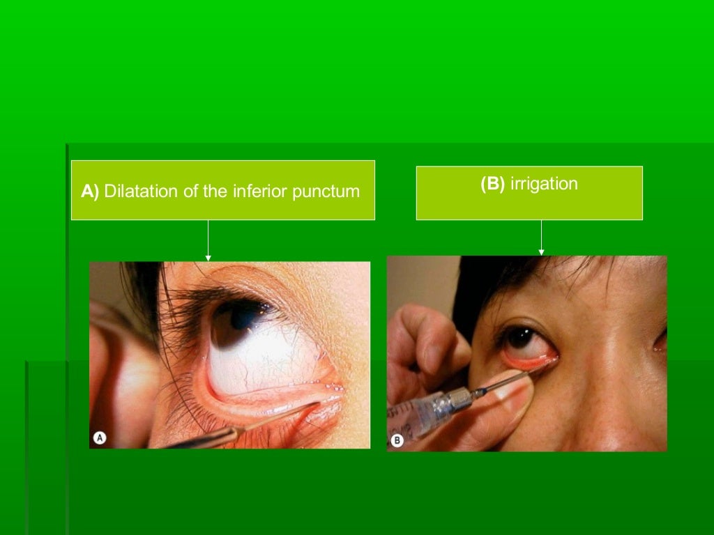 Eye presentation causes of a watering eye and evaluation,dr.mohammad