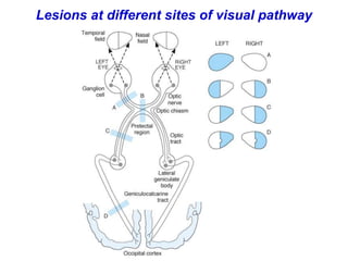 Lesions at different sites of visual pathway
 