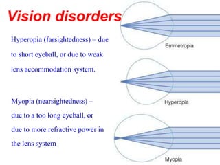 Hyperopia (farsightedness) – due
to short eyeball, or due to weak
lens accommodation system.
Myopia (nearsightedness) –
due to a too long eyeball, or
due to more refractive power in
the lens system
Vision disorders
 