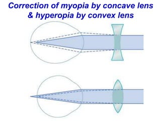 Correction of myopia by concave lens
& hyperopia by convex lens
 