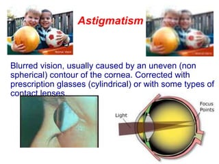 Astigmatism
Blurred vision, usually caused by an uneven (non
spherical) contour of the cornea. Corrected with
prescription glasses (cylindrical) or with some types of
contact lenses.
 
