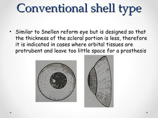 Conventional shell type
Conventional shell type
• Similar to Snellen reform eye but is designed so that
the thickness of the scleral portion is less, therefore
it is indicated in cases where orbital tissues are
protrubent and leave too little space for a prosthesis
 
