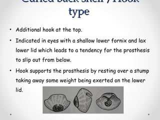 Curled back shell /Hook
Curled back shell /Hook
type
type
• Additional hook at the top.
• Indicated in eyes with a shallow lower fornix and lax
lower lid which leads to a tendency for the prosthesis
to slip out from below.
• Hook supports the prosthesis by resting over a stump
taking away some weight being exerted on the lower
lid.
 