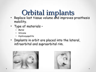 Orbital implants
Orbital implants
• Replace lost tissue volume and improves prosthesis
mobility.
• Type of materials –
o Metal
o Silicone
o Hydroxyapatite
• Implants in orbit are placed into the lateral,
infraorbital and supraorbital rim.
 