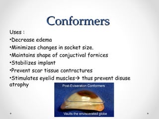 Conformers
Conformers
Uses :
•Decrease edema
•Minimizes changes in socket size.
•Maintains shape of conjuctival fornices
•Stabilizes implant
•Prevent scar tissue contractures
•Stimulates eyelid muscles thus prevent disuse
atrophy
 