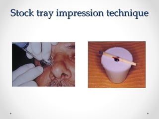 Stock tray impression technique
Stock tray impression technique
 