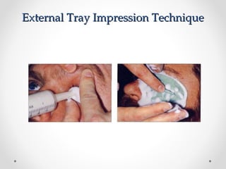 External Tray Impression Technique
External Tray Impression Technique
 