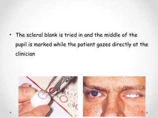 • The scleral blank is tried in and the middle of the
pupil is marked while the patient gazes directly at the
clinician
 