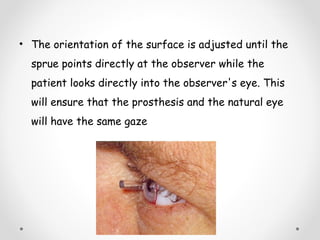 • The orientation of the surface is adjusted until the
sprue points directly at the observer while the
patient looks directly into the observer's eye. This
will ensure that the prosthesis and the natural eye
will have the same gaze
 