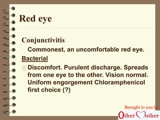 Red eye 
Conjunctivitis 
Commonest, an uncomfortable red eye. 
Bacterial 
 Discomfort. Purulent discharge. Spreads 
from one eye to the other. Vision normal. 
Uniform engorgement Chloramphenicol 
first choice (?) 
Brought to you by 
 