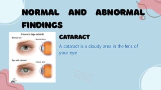 A cataract is a cloudy area in the lens of
your eye
 