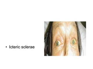 Icteric sclerae 