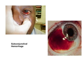 Subconjunctival Hemorrhage 