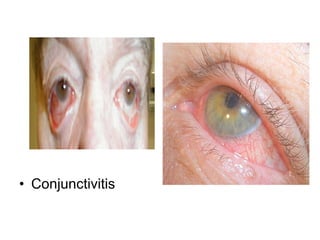 Conjunctivitis  