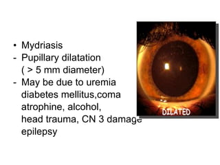 Mydriasis  Pupillary dilatation ( > 5 mm diameter) May be due to uremia diabetes mellitus,coma atrophine, alcohol, head trauma, CN 3 damage epilepsy 