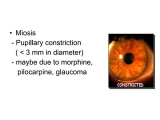 Miosis  - Pupillary constriction ( < 3 mm in diameter) - maybe due to morphine, pilocarpine, glaucoma 