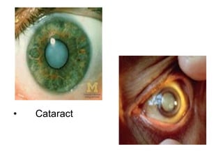Cataract  