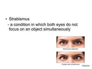 Strabismus  - a condition in which both eyes do not focus on an object simultaneously 