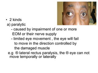 2 kinds a) paralytic - caused by impairment of one or more  EOM or their nerve supply - limited eye movement , the eye will fail to move in the direction controlled by the damaged muscle e.g  ® lateral rectus paralysis, the ® eye can not move temporally or laterally  
