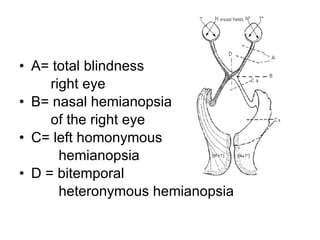 A= total blindness right eye B= nasal hemianopsia of the right eye C= left homonymous hemianopsia  D = bitemporal  heteronymous hemianopsia 