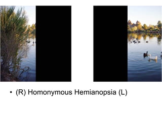 (R) Homonymous Hemianopsia (L) 