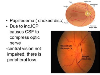 Papilledema ( choked disc) Due to inc.ICP causes CSF to compress optic nerve -central vision not impaired, there is peripheral loss 