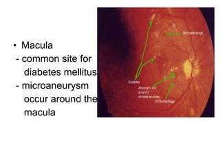 Macula  - common site for  diabetes mellitus - microaneurysm occur around the  macula 