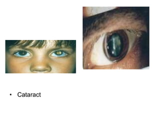 Cataract 