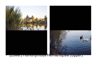 (Lower) Homonymous Hemianopsia (Upper) 