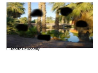 Diabetic Retinopathy 