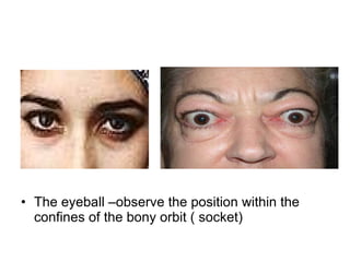 The eyeball –observe the position within the confines of the bony orbit ( socket) 