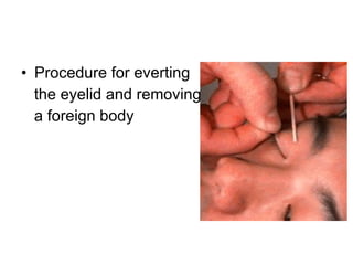 Procedure for everting the eyelid and removing a foreign body 