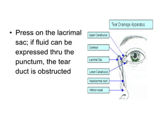 Press on the lacrimal sac; if fluid can be expressed thru the punctum, the tear duct is obstructed 