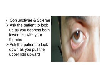 Conjunctivae & Sclerae Ask the patient to look up as you depress both lower lids with your  thumbs Ask the patient to look down as you pull the  upper lids upward 