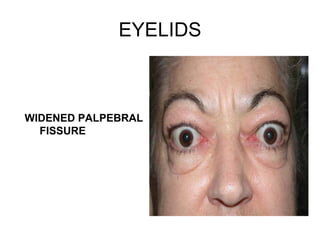 EYELIDS WIDENED PALPEBRAL FISSURE 