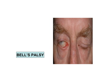 BELL’S PALSY 