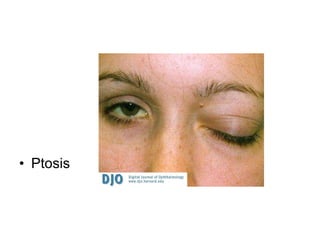 Ptosis  