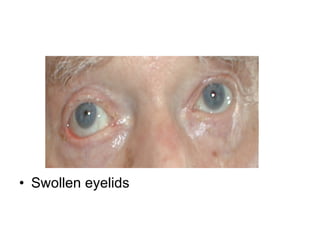 Swollen eyelids 