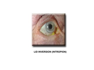 LID INVERSION (INTROPION) 