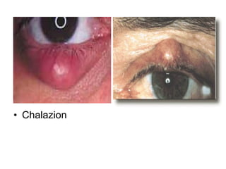 Chalazion  