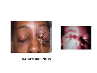 DACRYOADENITIS 