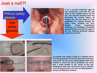 A carpenter was nailing a cleat on a scaffold board.
The nail apparently hit a knot in the wood causing it
to fly back into the man’s safety glasses with such
velocity to cause the nail to penetrate. The result
was a small scratch to the corner of the eye.
Subsequent tests were carried out to try to hammer
a nail through the lens of a pair of safety glasses –
that proved difficult to achieve.
Without safety
glasses
With
safety
glasses
A do it yourself enthusiast aged 32
was hammering a nail into his roof
when he felt a sudden pain in his left
eye. The nail had bounced back and
perforated the corneal limbus. At
surgery the nail was found to have
penetrated the vitreous through the
ciliary body, avoiding the lens.
Despite having prophylactic
antibiotics he developed intractable
endophthalmitis and lost the sight of
the eye. Wearing protective glasses
would have saved it.
Just a nail?!
 