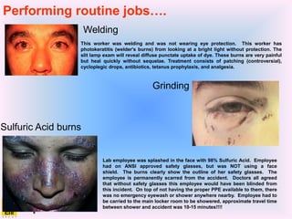 This worker was welding and was not wearing eye protection. This worker has
photokeratitis (welder's burns) from looking at a bright light without protection. The
slit lamp exam will reveal diffuse punctate uptake of dye. These burns are very painful
but heal quickly without sequelae. Treatment consists of patching (controversial),
cycloplegic drops, antibiotics, tetanus prophylaxis, and analgesia.
Welding
Grinding
Lab employee was splashed in the face with 98% Sulfuric Acid. Employee
had on ANSI approved safety glasses, but was NOT using a face
shield. The burns clearly show the outline of her safety glasses. The
employee is permanently scarred from the accident. Doctors all agreed
that without safety glasses this employee would have been blinded from
this incident. On top of not having the proper PPE available to them, there
was no emergency eyewash or shower anywhere nearby. Employee had to
be carried to the main locker room to be showered, approximate travel time
between shower and accident was 10-15 minutes!!!!
Sulfuric Acid burns
Performing routine jobs….
 