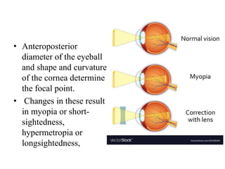 • Anteroposterior
diameter of the eyeball
and shape and curvature
of the cornea determine
the focal point.
• Changes in these result
in myopia or short-
sightedness,
hypermetropia or
longsightedness,
 