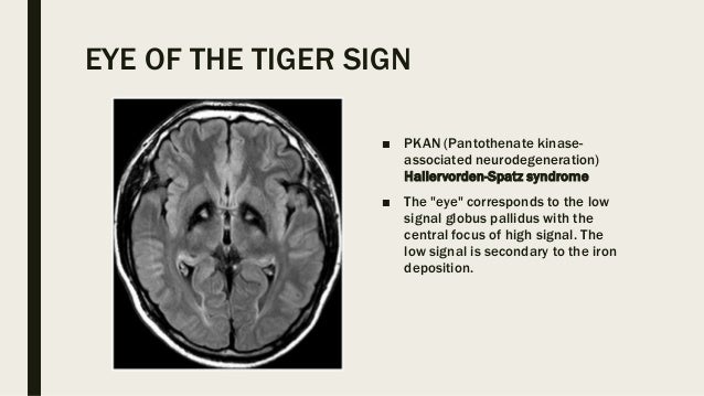 Eye Signs In Radiology Eye Signs In Radiology