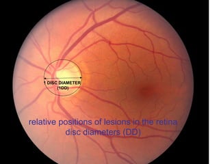 1 DISC DIAMETER
(1DD)
relative positions of lesions in the retina
disc diameters (DD)
 