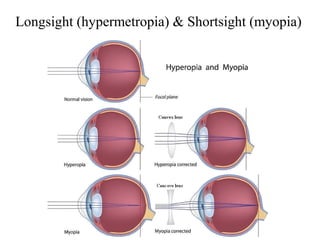 Longsight (hypermetropia) & Shortsight (myopia)
 