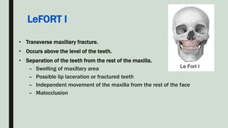 • Transverse maxillary fracture.
• Occurs above the level of the teeth.
• Separation of the teeth from the rest of the maxilla.
– Swelling of maxillary area
– Possible lip laceration or fractured teeth
– Independent movement of the maxilla from the rest of the face
– Malocclusion
LeFORT I
 