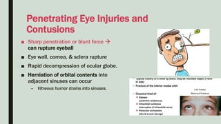 Penetrating Eye Injuries and
Contusions
■ Sharp penetration or blunt force 
can rupture eyeball
■ Eye wall, cornea, & sclera rupture
■ Rapid decompression of ocular globe.
■ Herniation of orbital contents into
adjacent sinuses can occur
– Vitreous humor drains into sinuses.
 