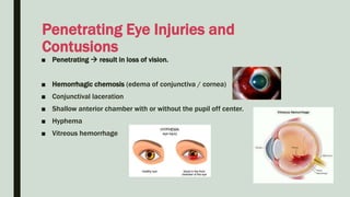 ■ Penetrating  result in loss of vision.
■ Hemorrhagic chemosis (edema of conjunctiva / cornea)
■ Conjunctival laceration
■ Shallow anterior chamber with or without the pupil off center.
■ Hyphema
■ Vitreous hemorrhage
Penetrating Eye Injuries and
Contusions
 